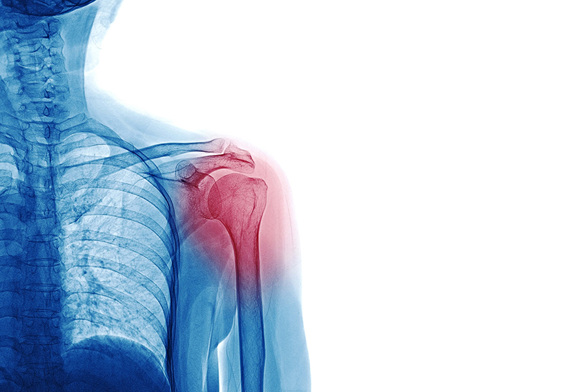 Shoulder dislocation +/- fracture, a common skiing injury