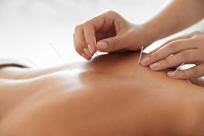 Acupuncture as part of your Physiotherapy or Chiropractic treatment